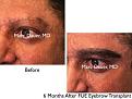 Click image for larger version

Name:	Hair Transplant Slides copy65.003.jpg
Views:	299
Size:	16.3 KB
ID:	478616