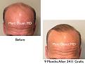 Click image for larger version

Name:	Hair Transplant Slides copy82.001.jpg
Views:	1743
Size:	12.0 KB
ID:	478687