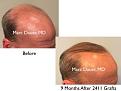 Click image for larger version

Name:	Hair Transplant Slides copy82.003.jpg
Views:	979
Size:	12.3 KB
ID:	478688
