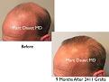 Click image for larger version

Name:	Hair Transplant Slides copy82.002.jpg
Views:	1471
Size:	12.1 KB
ID:	478689