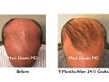 Click image for larger version

Name:	Hair Transplant Slides copy82.004.jpg
Views:	4724
Size:	14.5 KB
ID:	478690
