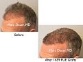 Click image for larger version

Name:	Hair Transplant Slides copy13.002.jpg
Views:	392
Size:	12.7 KB
ID:	478766