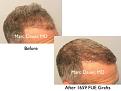 Click image for larger version

Name:	Hair Transplant Slides copy13.003.jpg
Views:	379
Size:	13.6 KB
ID:	478767