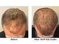 Click image for larger version

Name:	Hair Transplant Slides copy13.004.jpg
Views:	411
Size:	17.3 KB
ID:	478768