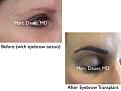 Click image for larger version

Name:	Hair Transplant Slides copy95.003.jpg
Views:	333
Size:	12.1 KB
ID:	478770