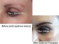 Click image for larger version

Name:	Hair Transplant Slides copy95.002.jpg
Views:	341
Size:	12.8 KB
ID:	478771