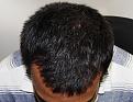 Click image for larger version

Name:	gr 1 year post chin down.jpg
Views:	409
Size:	95.4 KB
ID:	478789