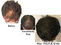 Click image for larger version

Name:	Hair Transplant Slides copy88.003.jpg
Views:	358
Size:	14.6 KB
ID:	478822