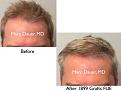 Click image for larger version

Name:	Hair Transplant Slides copy91.001.jpg
Views:	367
Size:	12.5 KB
ID:	478861