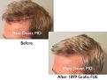 Click image for larger version

Name:	Hair Transplant Slides copy86.002.jpg
Views:	328
Size:	13.5 KB
ID:	478863