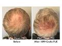 Click image for larger version

Name:	Hair Transplant Slides copy86.004.jpg
Views:	452
Size:	16.8 KB
ID:	478865