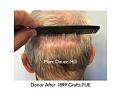 Click image for larger version

Name:	Hair Transplant Slides copy86.005.jpg
Views:	361
Size:	14.2 KB
ID:	478866