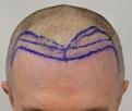 Click image for larger version

Name:	pre-op (5).JPG
Views:	389
Size:	23.6 KB
ID:	478932