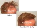 Click image for larger version

Name:	Hair Transplant Slides copy91.002.jpg
Views:	362
Size:	13.2 KB
ID:	478978