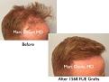 Click image for larger version

Name:	Hair Transplant Slides copy91.002.jpg
Views:	443
Size:	13.2 KB
ID:	478978