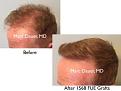 Click image for larger version

Name:	Hair Transplant Slides copy91.003.jpg
Views:	363
Size:	12.5 KB
ID:	478979