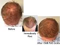 Click image for larger version

Name:	Hair Transplant Slides copy91.004.jpg
Views:	460
Size:	14.5 KB
ID:	478980