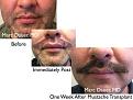 Click image for larger version

Name:	Hair Transplant Slides copy72.001.jpg
Views:	301
Size:	15.1 KB
ID:	478989