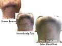 Click image for larger version

Name:	Hair Transplant Slides copy72.002.jpg
Views:	282
Size:	14.4 KB
ID:	478990