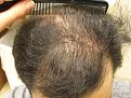 Click image for larger version

Name:	1-8-2016 6 months-T- after surgery003.jpg
Views:	403
Size:	95.9 KB
ID:	478998