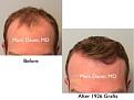 Click image for larger version

Name:	Hair Transplant Slides copy01.001.jpg
Views:	457
Size:	12.1 KB
ID:	479099