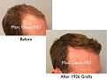 Click image for larger version

Name:	Hair Transplant Slides copy01.003.jpg
Views:	420
Size:	11.7 KB
ID:	479101