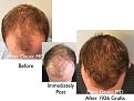Click image for larger version

Name:	Hair Transplant Slides copy01.004.jpg
Views:	469
Size:	16.0 KB
ID:	479102