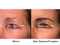 Click image for larger version

Name:	Hair Transplant Slides copy111.003.jpg
Views:	300
Size:	13.8 KB
ID:	479163