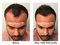 Click image for larger version

Name:	Hair Transplant Slides copy113.001.jpg
Views:	306
Size:	16.9 KB
ID:	479203