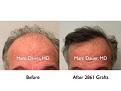 Click image for larger version

Name:	Hair Transplant Slides copy141.001.jpg
Views:	292
Size:	12.0 KB
ID:	479378