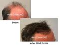 Click image for larger version

Name:	Hair Transplant Slides copy141.003.jpg
Views:	393
Size:	12.8 KB
ID:	479379
