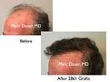 Click image for larger version

Name:	Hair Transplant Slides copy141.002.jpg
Views:	291
Size:	12.1 KB
ID:	479380