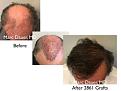 Click image for larger version

Name:	Hair Transplant Slides copy141.004.jpg
Views:	304
Size:	12.6 KB
ID:	479381