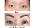 Click image for larger version

Name:	Hair Transplant Slides copy161.003.jpg
Views:	341
Size:	12.8 KB
ID:	479382