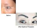 Click image for larger version

Name:	Hair Transplant Slides copy161.001.jpg
Views:	321
Size:	10.7 KB
ID:	479384