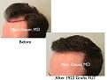 Click image for larger version

Name:	Hair Transplant Slides copy229.002.jpg
Views:	452
Size:	11.3 KB
ID:	479459