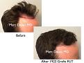 Click image for larger version

Name:	Hair Transplant Slides copy229.003.jpg
Views:	463
Size:	12.3 KB
ID:	479460