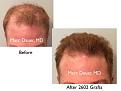 Click image for larger version

Name:	Hair Transplant Slides copy515.001.jpg
Views:	346
Size:	11.8 KB
ID:	479608