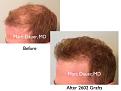 Click image for larger version

Name:	Hair Transplant Slides copy515.002.jpg
Views:	391
Size:	12.4 KB
ID:	479609