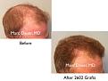 Click image for larger version

Name:	Hair Transplant Slides copy515.003.jpg
Views:	391
Size:	12.1 KB
ID:	479610