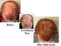 Click image for larger version

Name:	Hair Transplant Slides copy515.004.jpg
Views:	347
Size:	14.0 KB
ID:	479611