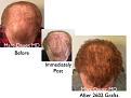Click image for larger version

Name:	Hair Transplant Slides copy515.004.jpg
Views:	430
Size:	14.0 KB
ID:	479611