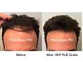 Click image for larger version

Name:	Hair Transplant Slides copy229.008.jpg
Views:	320
Size:	13.5 KB
ID:	479643