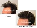 Click image for larger version

Name:	Hair Transplant Slides copy229.007.jpg
Views:	274
Size:	11.6 KB
ID:	479644