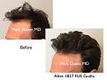 Click image for larger version

Name:	Hair Transplant Slides copy229.007.jpg
Views:	352
Size:	11.6 KB
ID:	479644