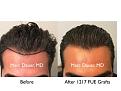 Click image for larger version

Name:	Hair Transplant Slides copy811.004.jpg
Views:	352
Size:	15.1 KB
ID:	479688