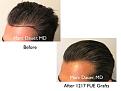 Click image for larger version

Name:	Hair Transplant Slides copy811.007.jpg
Views:	279
Size:	12.6 KB
ID:	479690