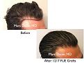 Click image for larger version

Name:	Hair Transplant Slides copy811.005.jpg
Views:	284
Size:	13.8 KB
ID:	479691