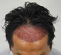 Click image for larger version

Name:	1 day post-op.jpg
Views:	346
Size:	78.9 KB
ID:	479735