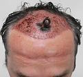 Click image for larger version

Name:	1 day post-op (1).jpg
Views:	378
Size:	89.5 KB
ID:	479818